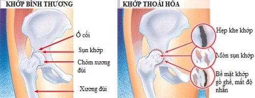 trieu-chung-thoai-hoa-khop-hang-nhu-the-nao